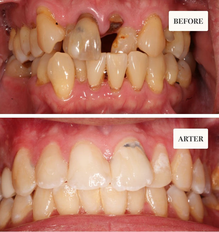Smile Restoration Before and After