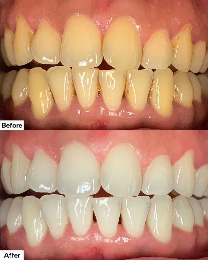 Porcelain Veneers Before and After