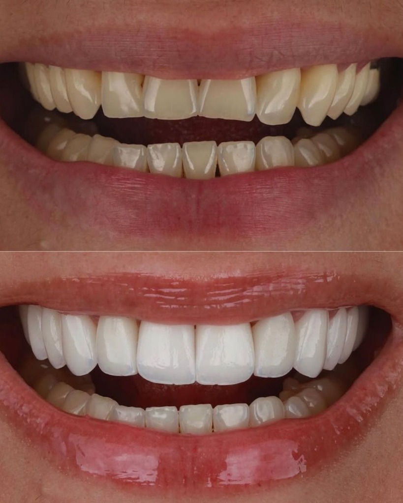 Veneers Design Before and After