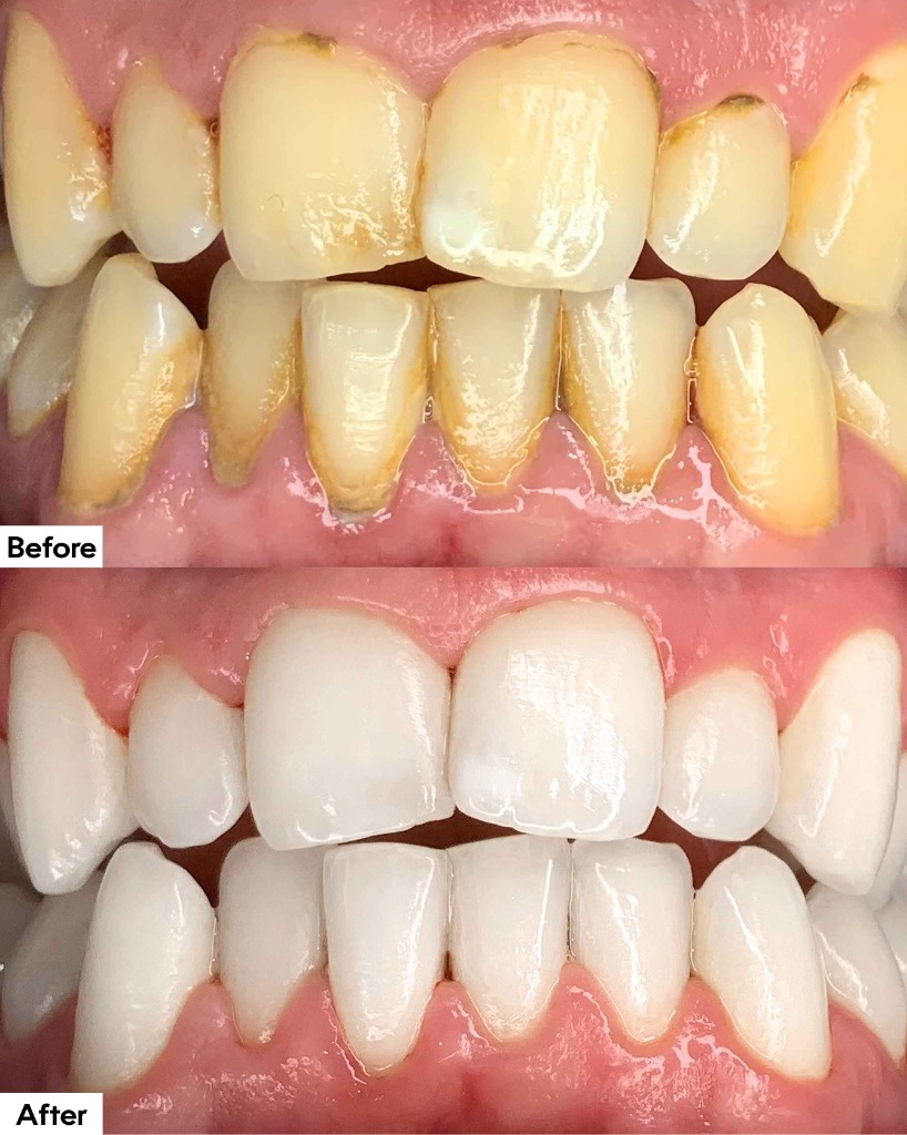 Gums and Teeth Correction Before and After